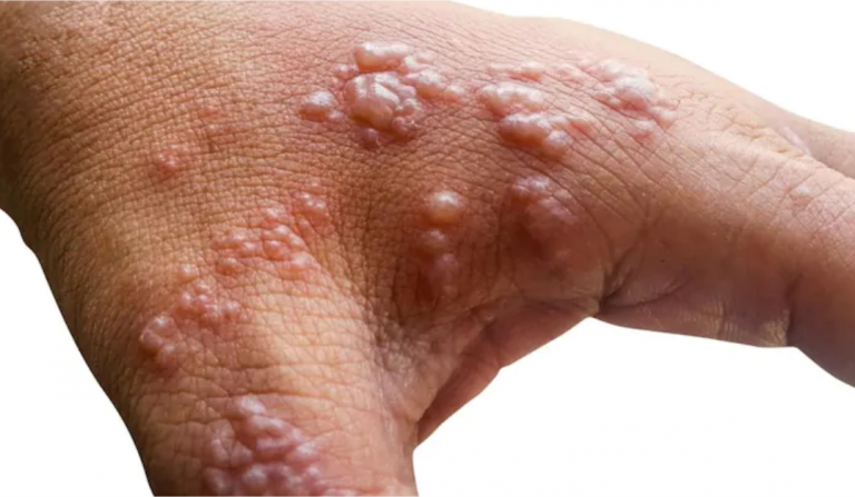 Monkeypox: WHO renames virus ‘mpox’ to avoid stigma