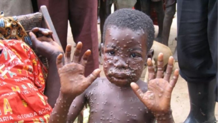 Nigeria records 6 cases of Monkeypox, 1 death in a month